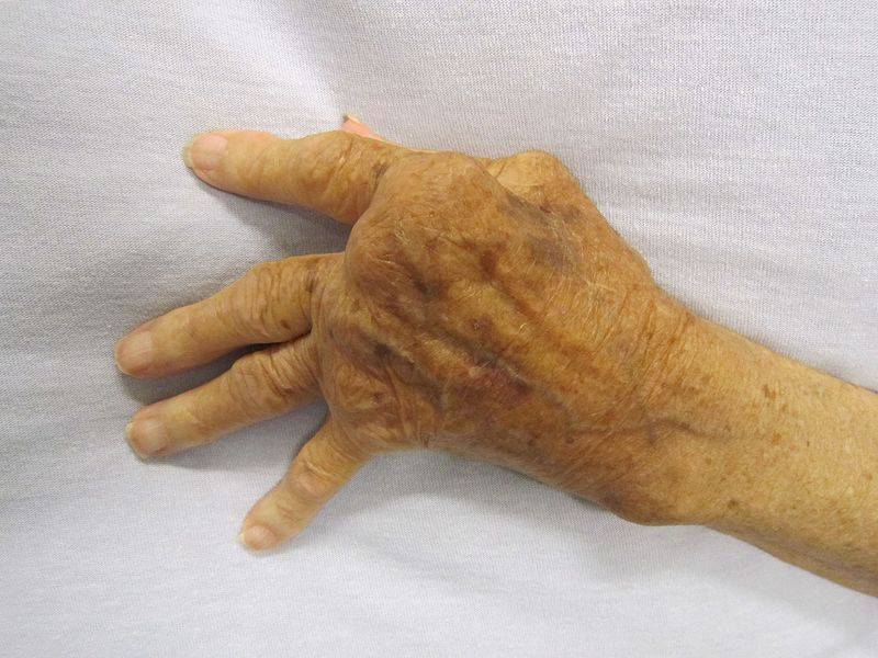 Artrite reumatoide, quali sono i sintomi?